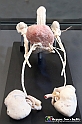 VBS_2562 - Prostata ingrossata - Mostra Body Worlds